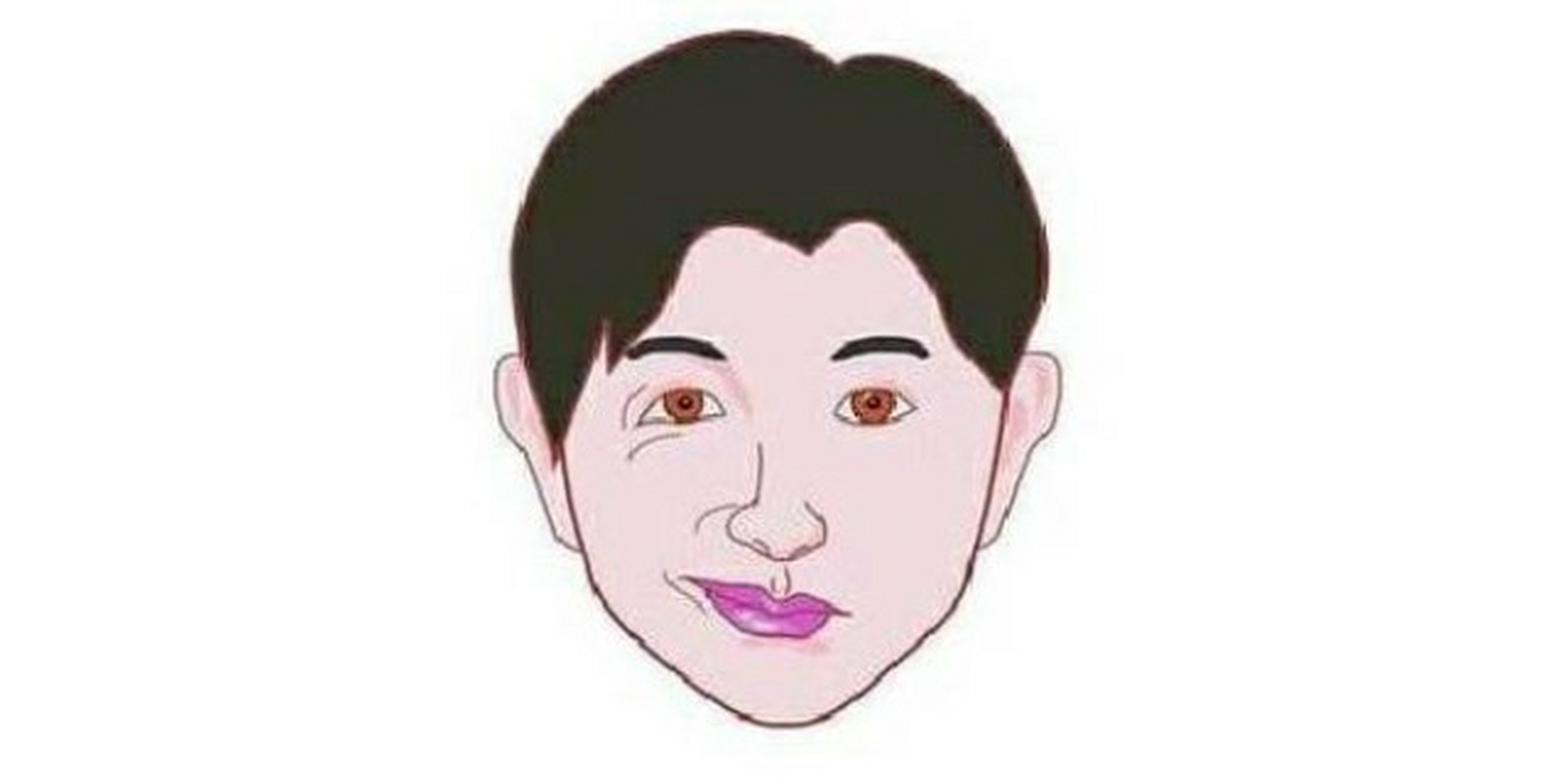 面肌痉挛,又称面肌抽搐,表现为一侧面部不自主抽搐.