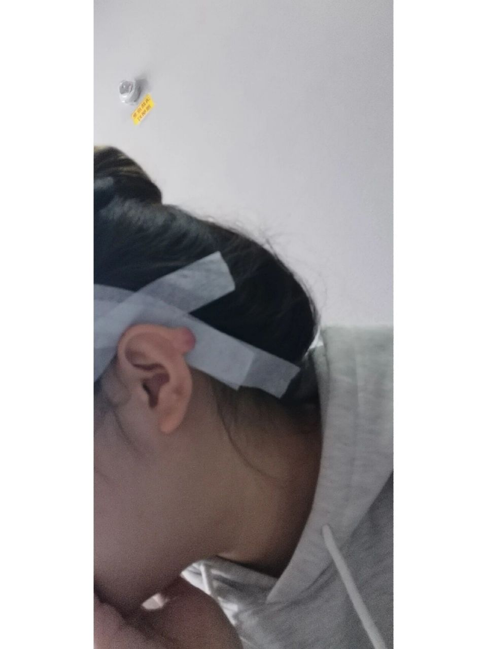 增生瘢痕手术 跟大家分享一下:我是花了二十块钱打的耳洞,在耳软骨上