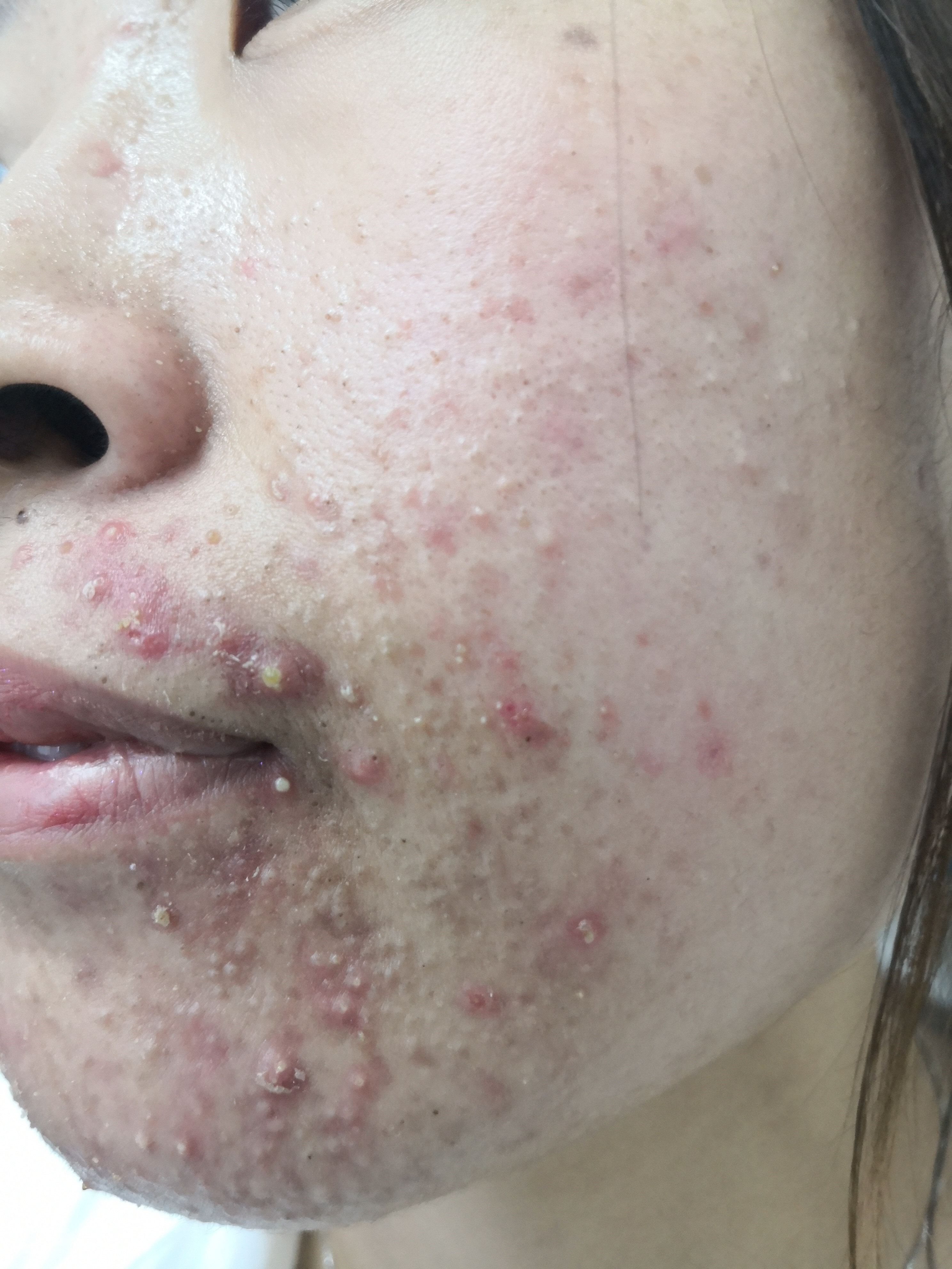 面部痤疮常见症状.额.@纪秀军皮肤科主任医师的动态