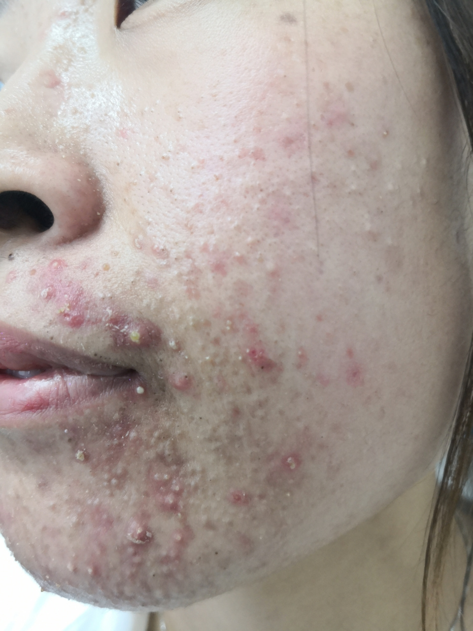 面部痤疮常见症状.额头面颊口周炎症性丘疹红斑脓疱明显.