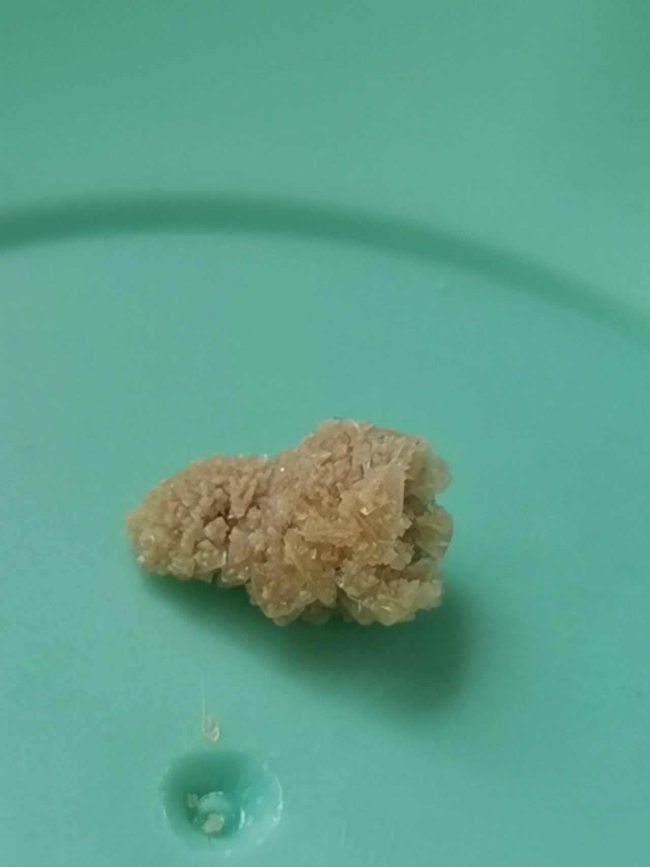 历时一个月,12*7mm结石终于出来了