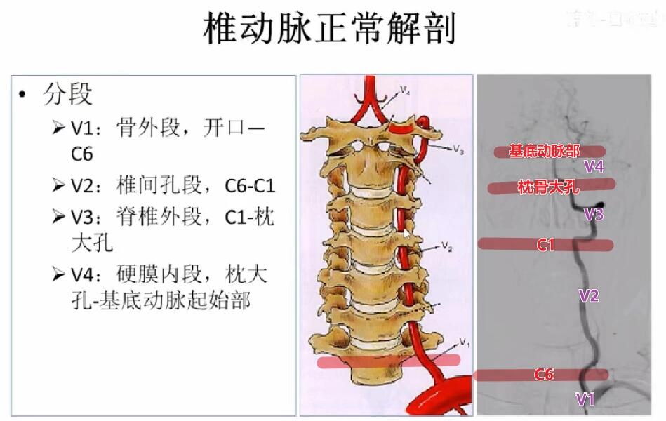 椎动脉5段法解剖图图片