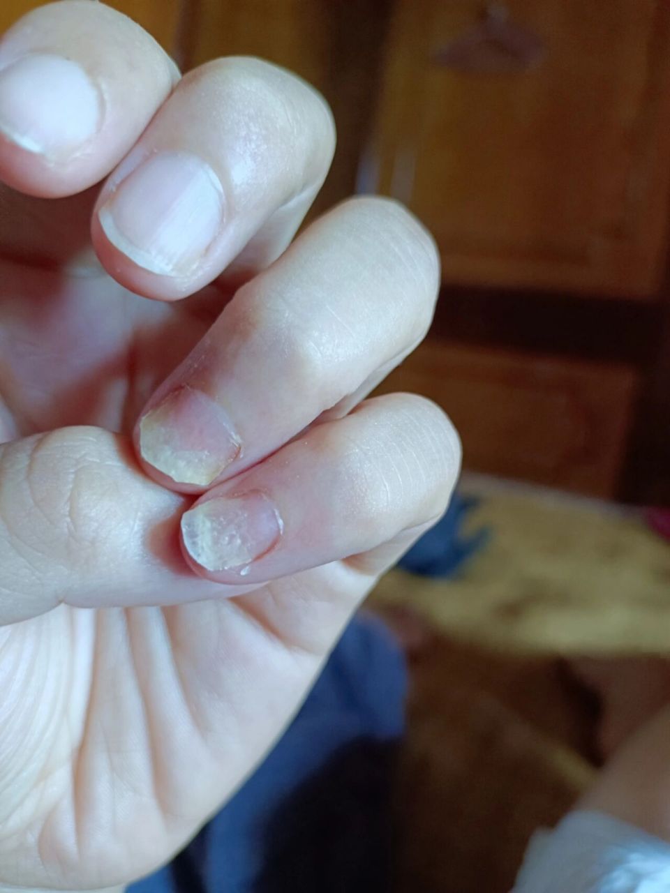 因为手上湿疹引起的指甲营养不良吗.