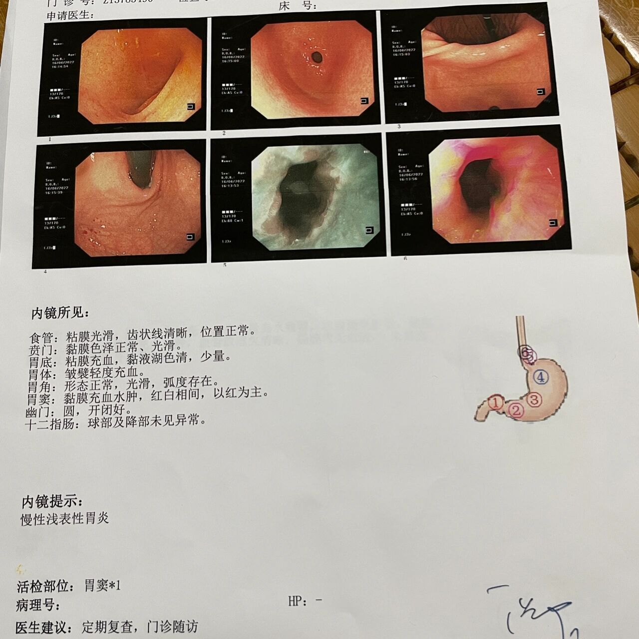 齿状线粘膜破损图片