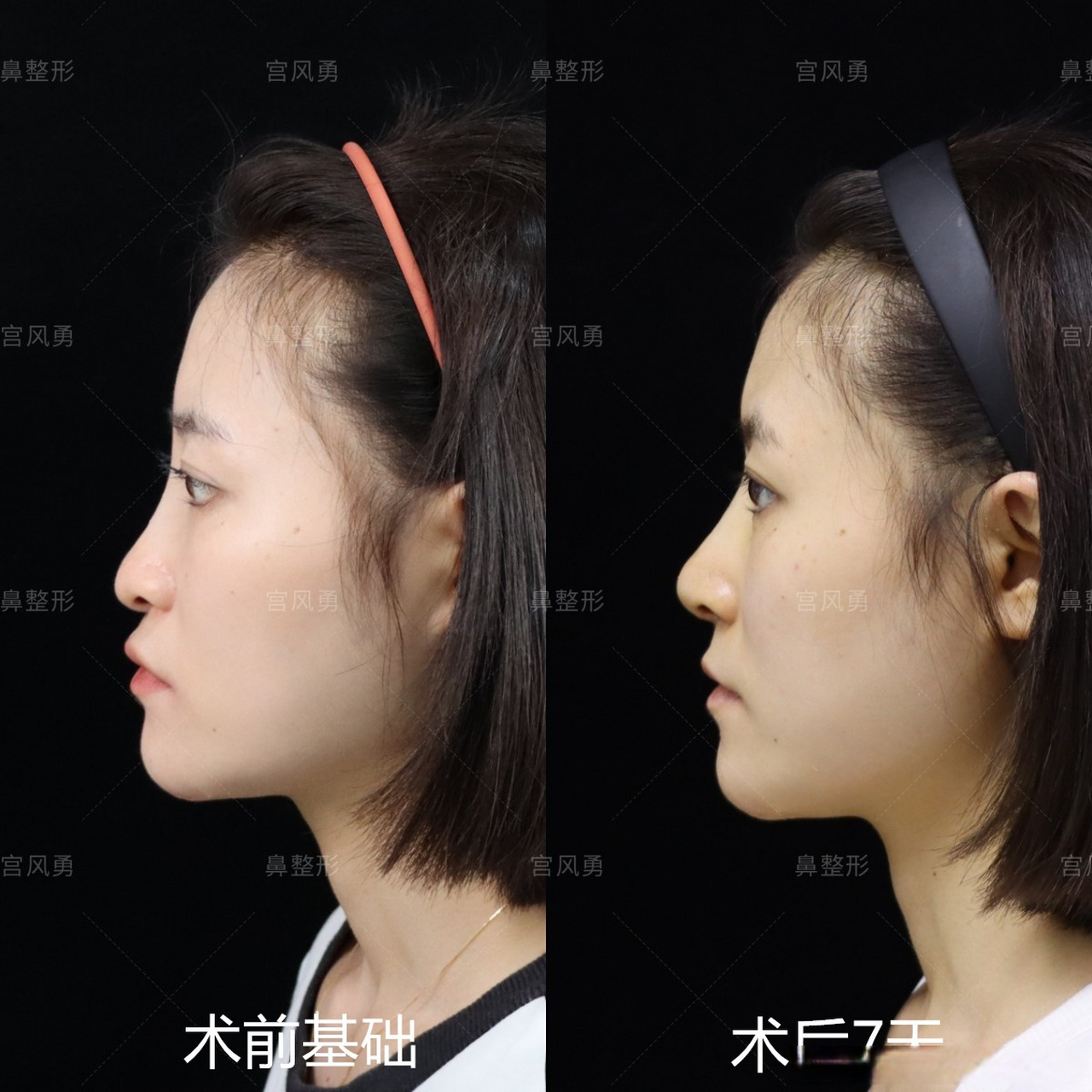 【如何摆脱显老的#箭头鼻# 】姑娘是典型的#箭头鼻# 表现形式为鼻尖