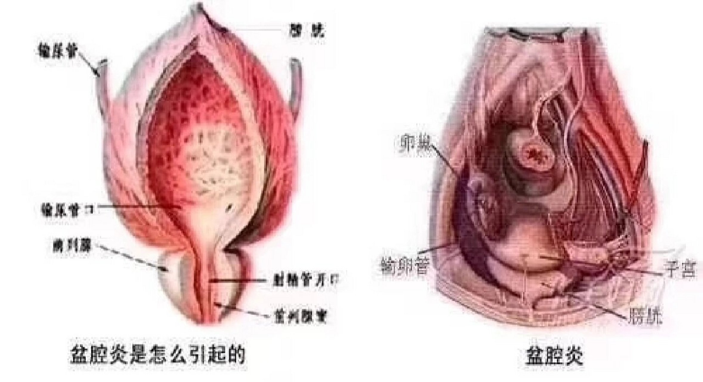 直肠子宫陷凹位置图图片