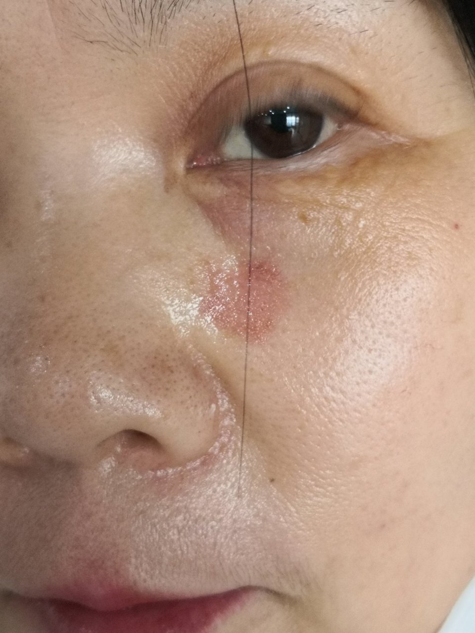 面部老年斑脂溢性角化激光治疗去除后恢复中#美容##解决皮肤问题专注