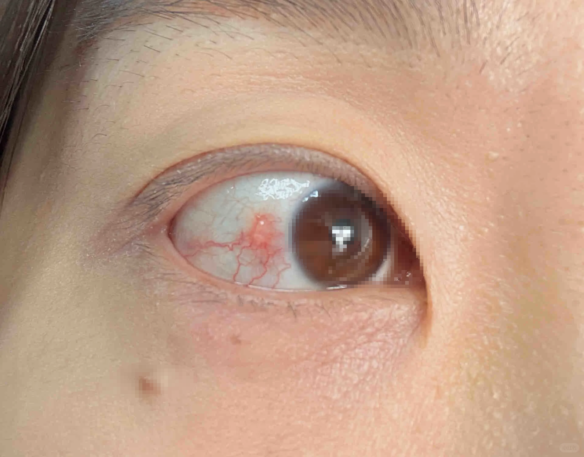 白眼球上出现透明水泡可能是过敏性结膜炎,睑裂斑或泡性结膜炎引起