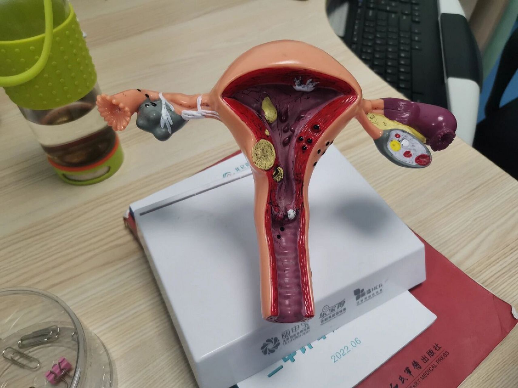 孕期宫颈息肉摘除 16周,终于把宫颈息肉手术做了,疼痛感有,但是能接受