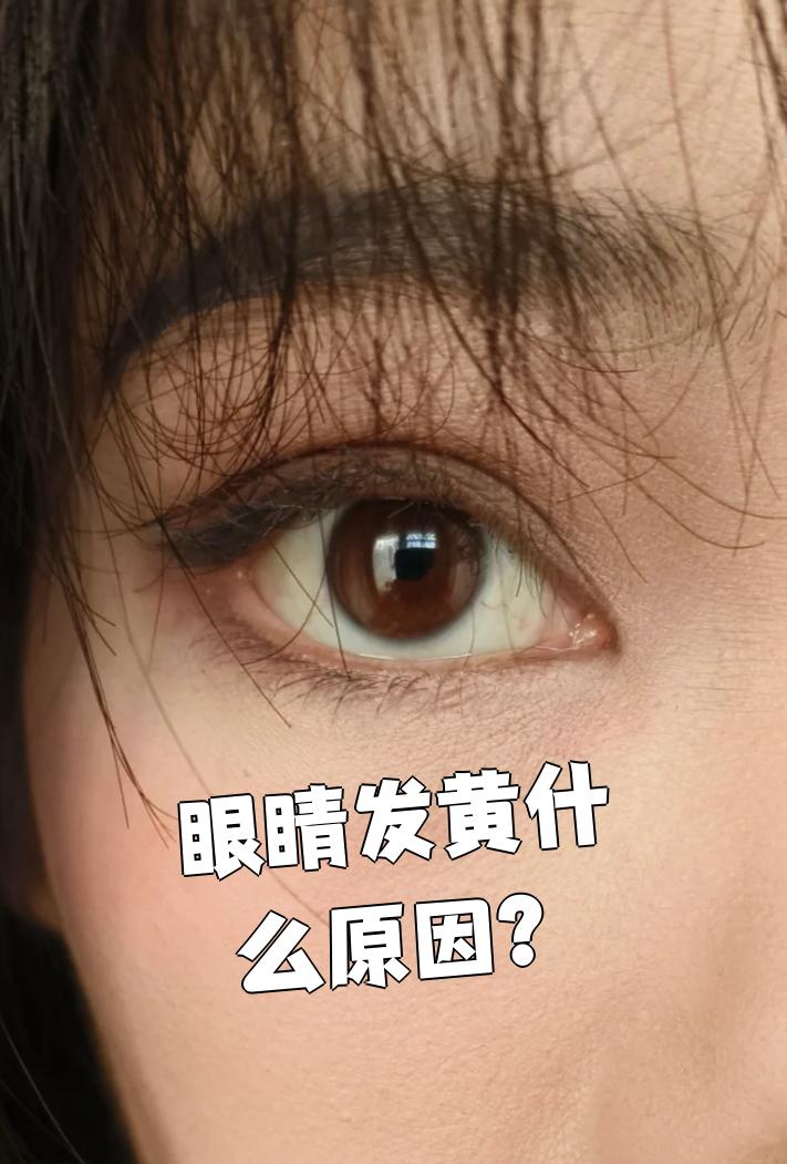 眼睛发黄可能由多种原因引起,最常见的是视疲劳,黄疸和色素含量过高