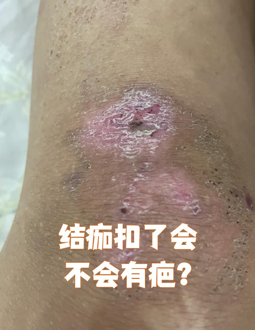 结痂为什么会很痒