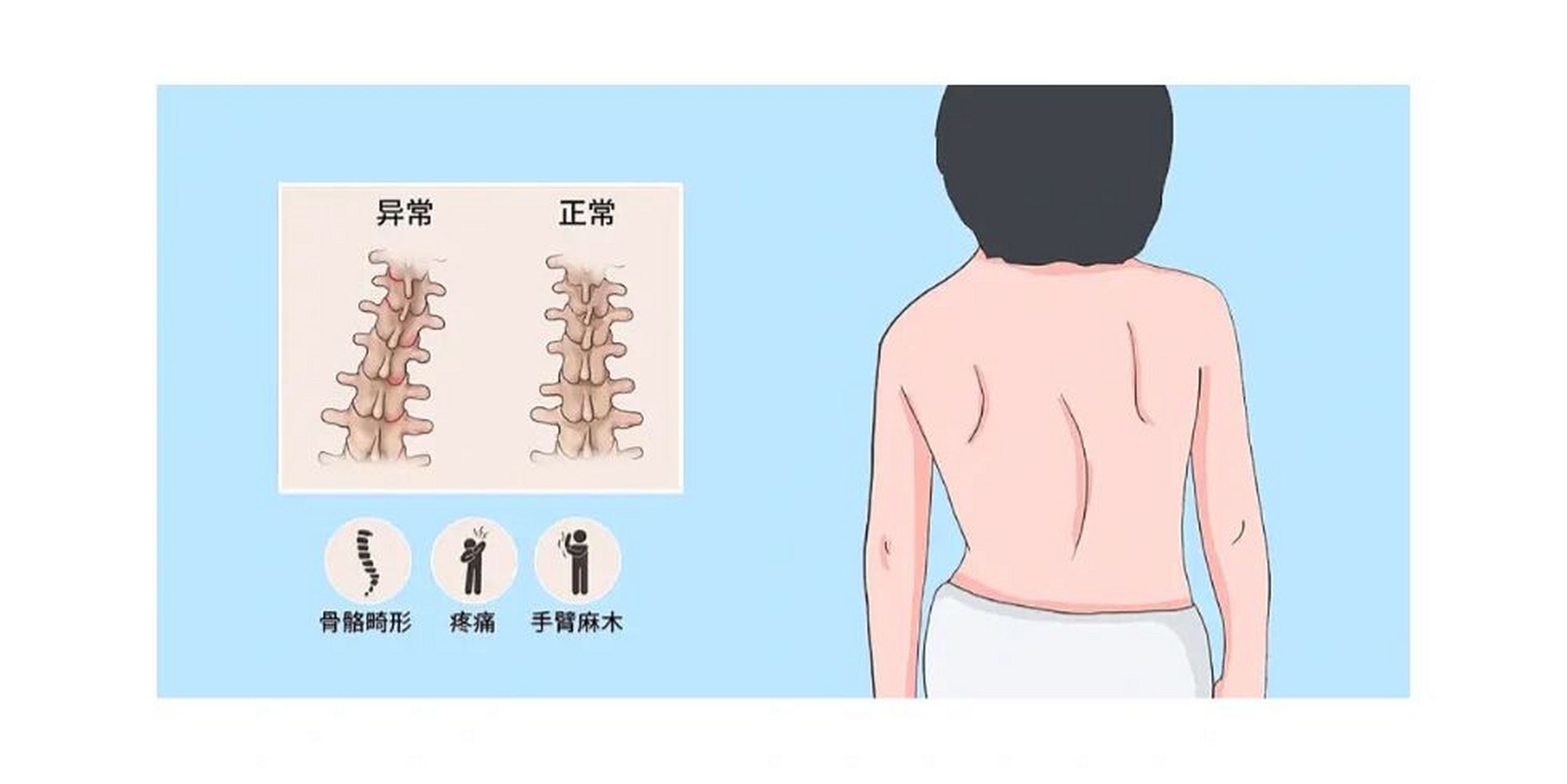 脊柱侧弯的卡通图片图片