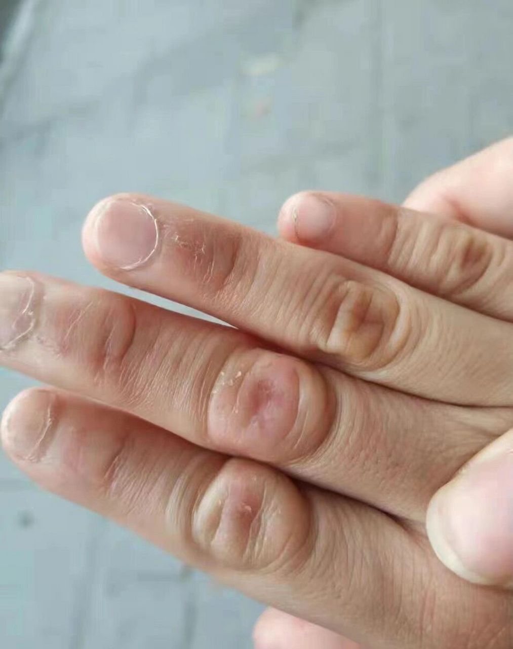 手指背"粗大隆起" 家长说十分难看,怎么办?