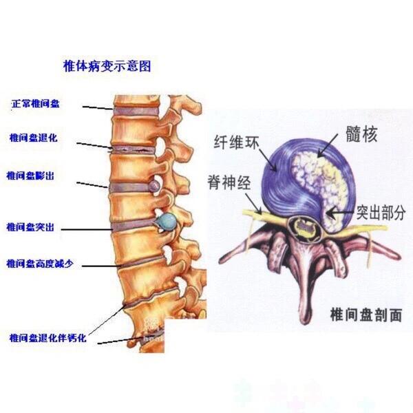 腰椎间盘位置结构图图片