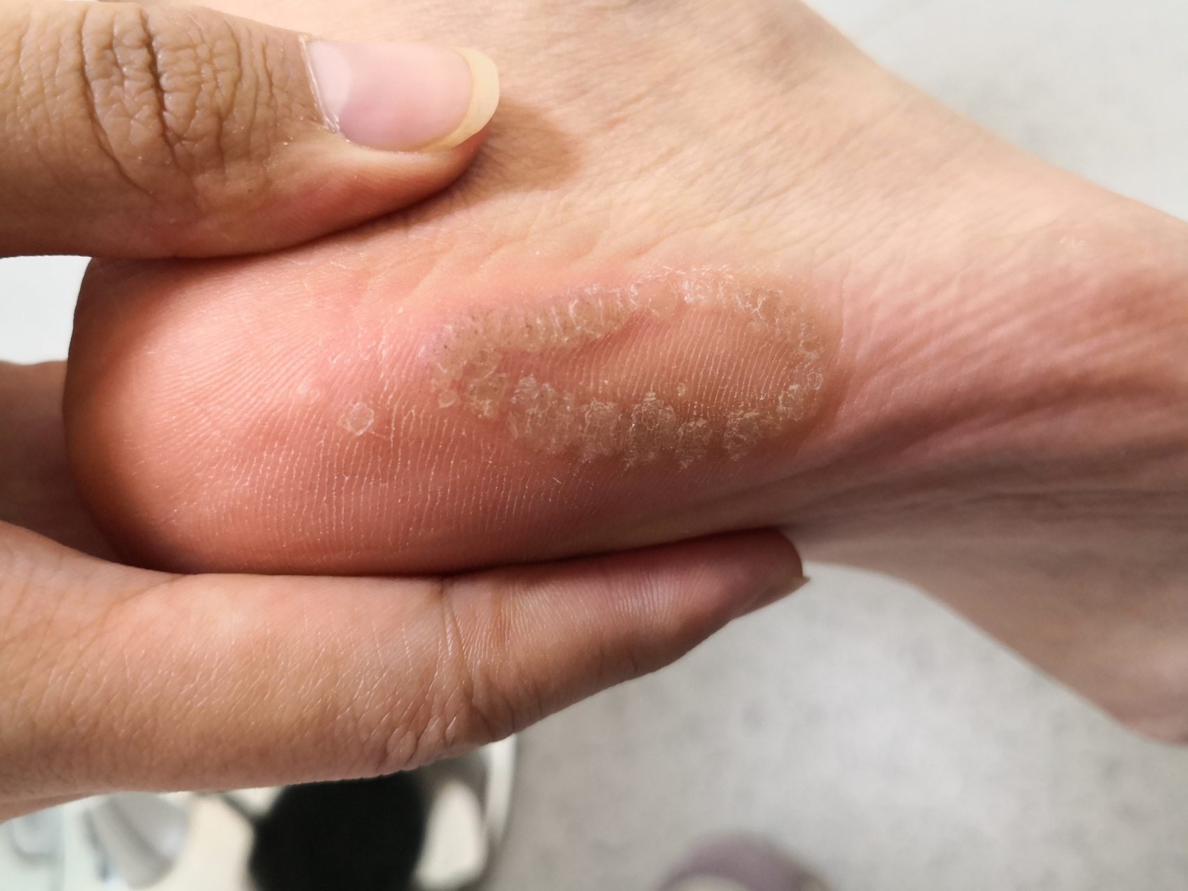 足底侧缘的环形排列的丘疹,中央有黑点,考虑跖疣.可以使用药物治疗.