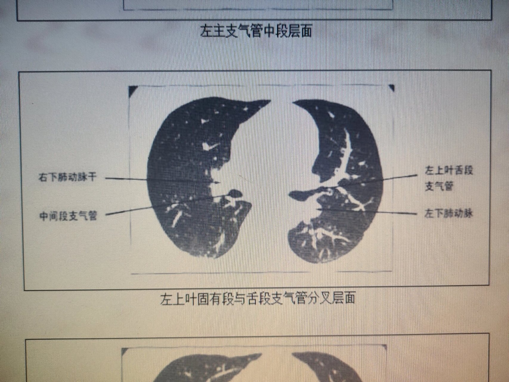 正常肺窗图片图片