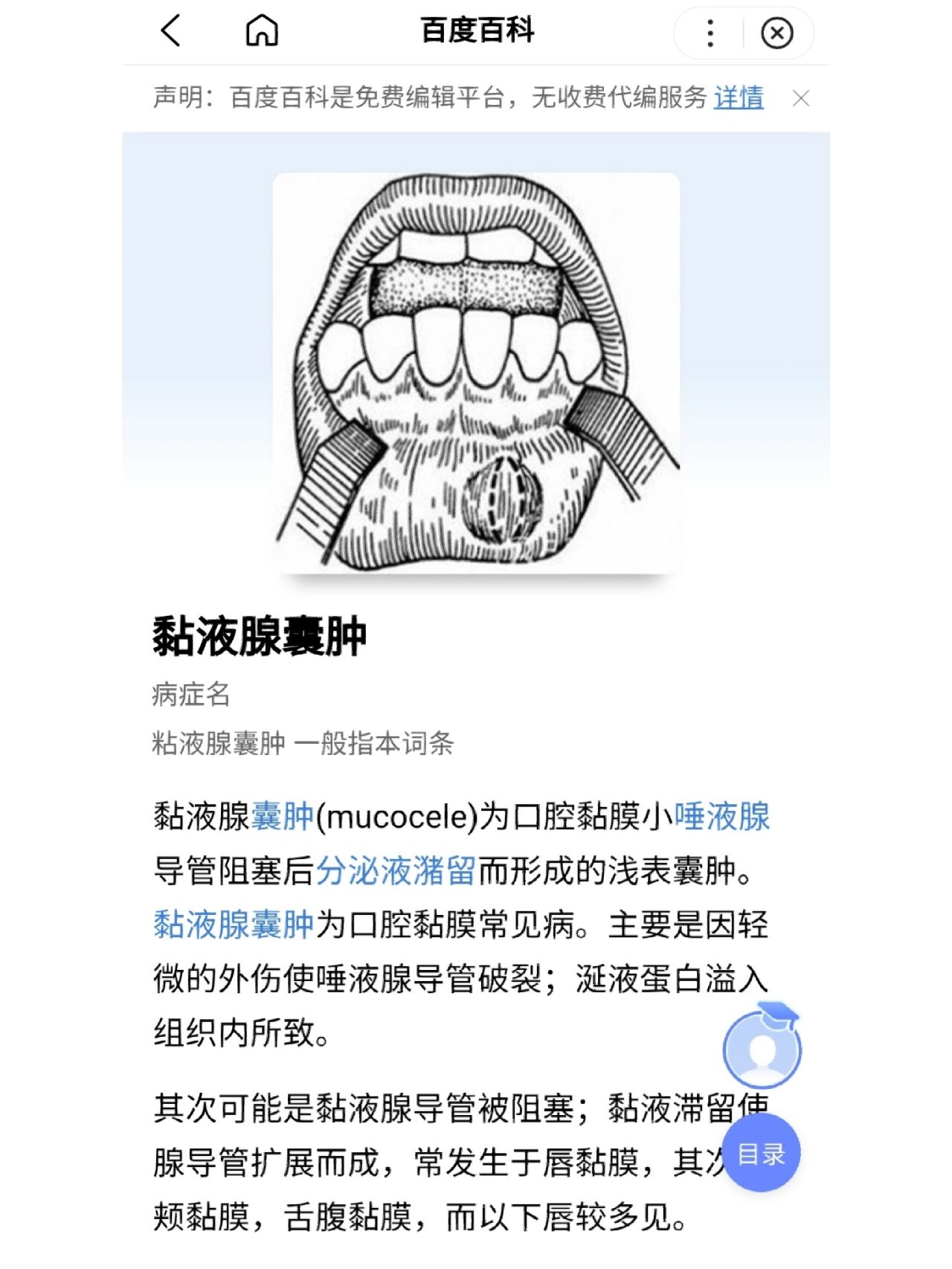 黏液腺囊肿自愈?