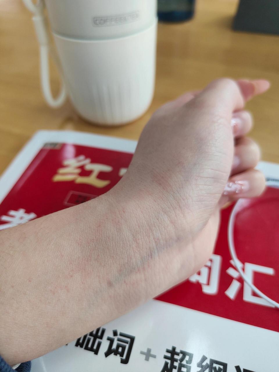 手背上的小红点 早上起来左手手背突然起了很多小红点,不痛不痒,半年