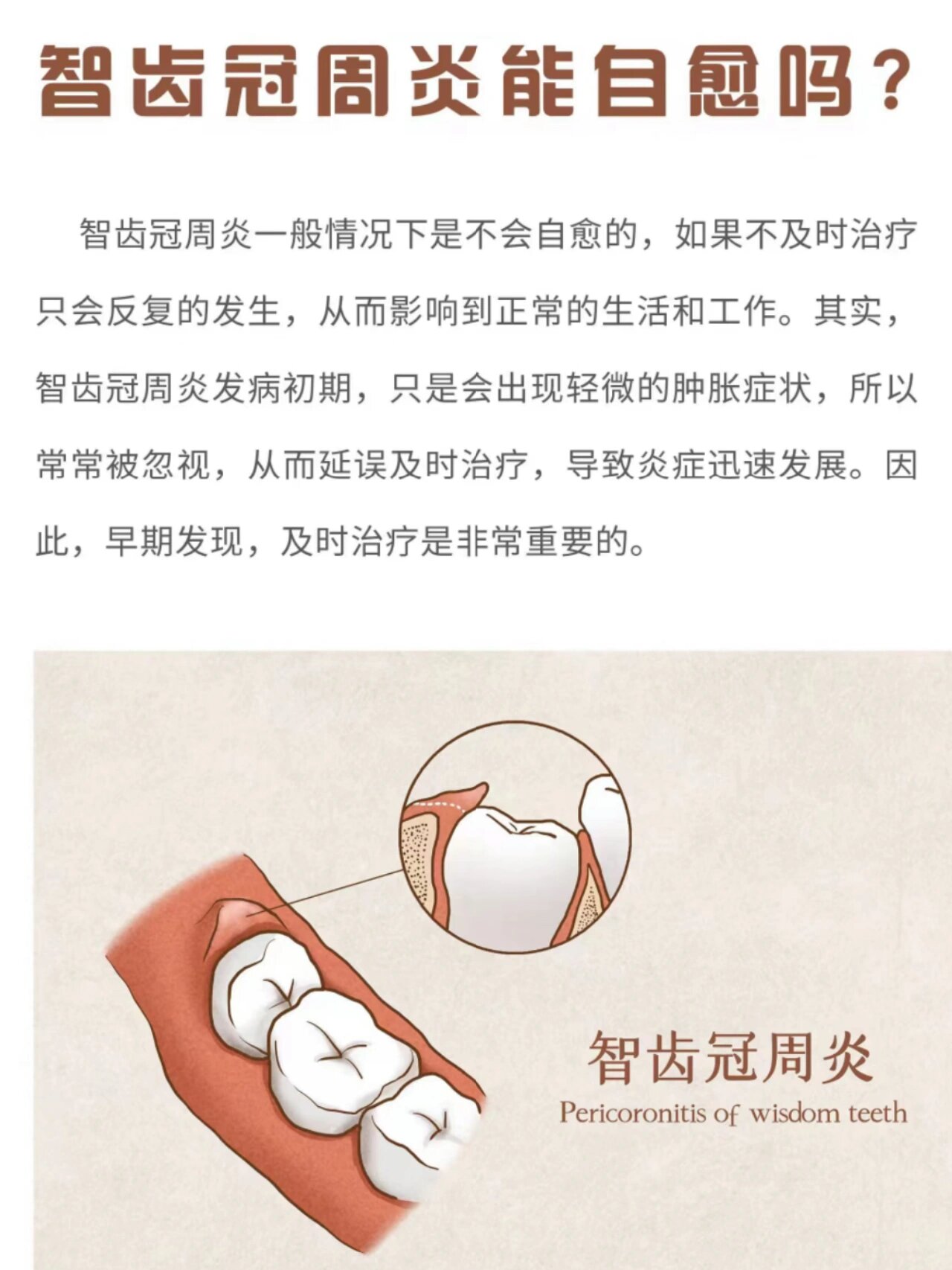 口腔知识科谱 奥泰口腔  口腔知识科谱 --------------- 智齿冠周炎能