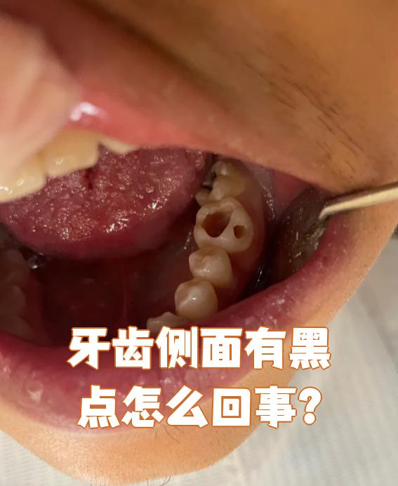 牙齿侧面出现黑点,最常见的原因是色素沉着或者龋病