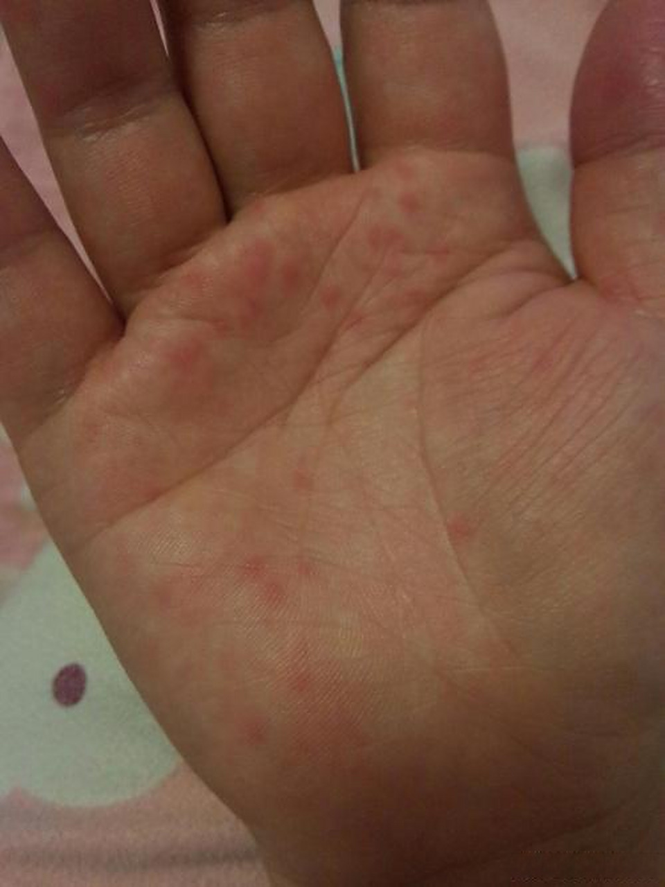 手上有小红点是什么原因?