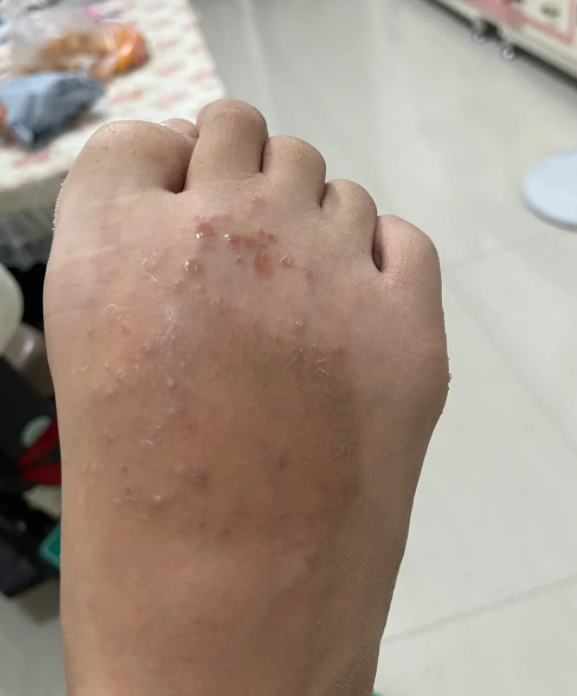 脚痒起水泡最常见的原因是脚部湿疹,汗疱疹和足癣