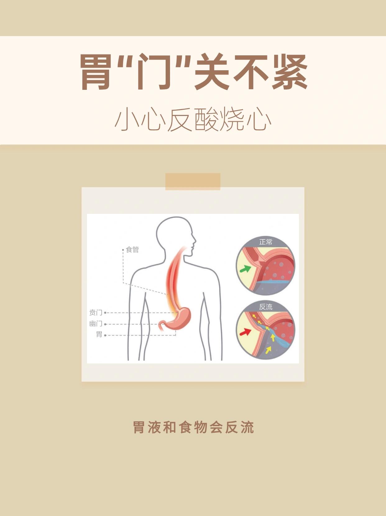 贲门口松弛图片