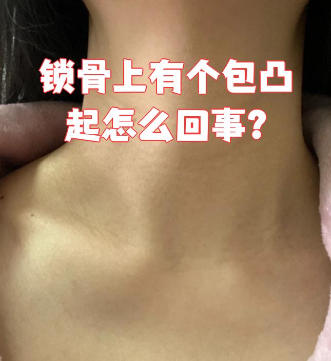锁骨表面脂肪层比较薄,锁骨的正常凸起就会更明显,摸起来像骨头一样硬