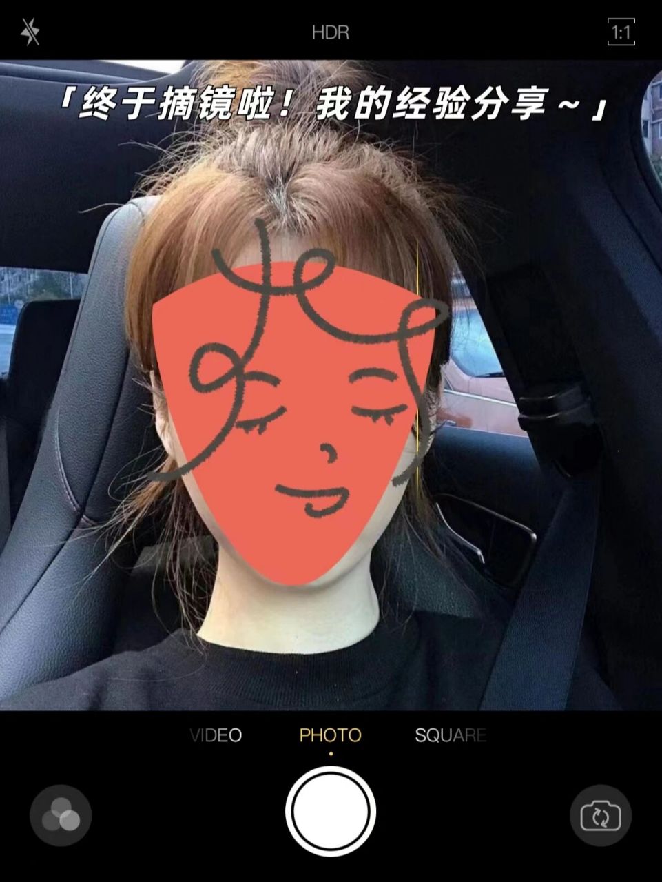 术后快一个月了,2000度超高度近视摘镜分享 99地点:本来就想是正规