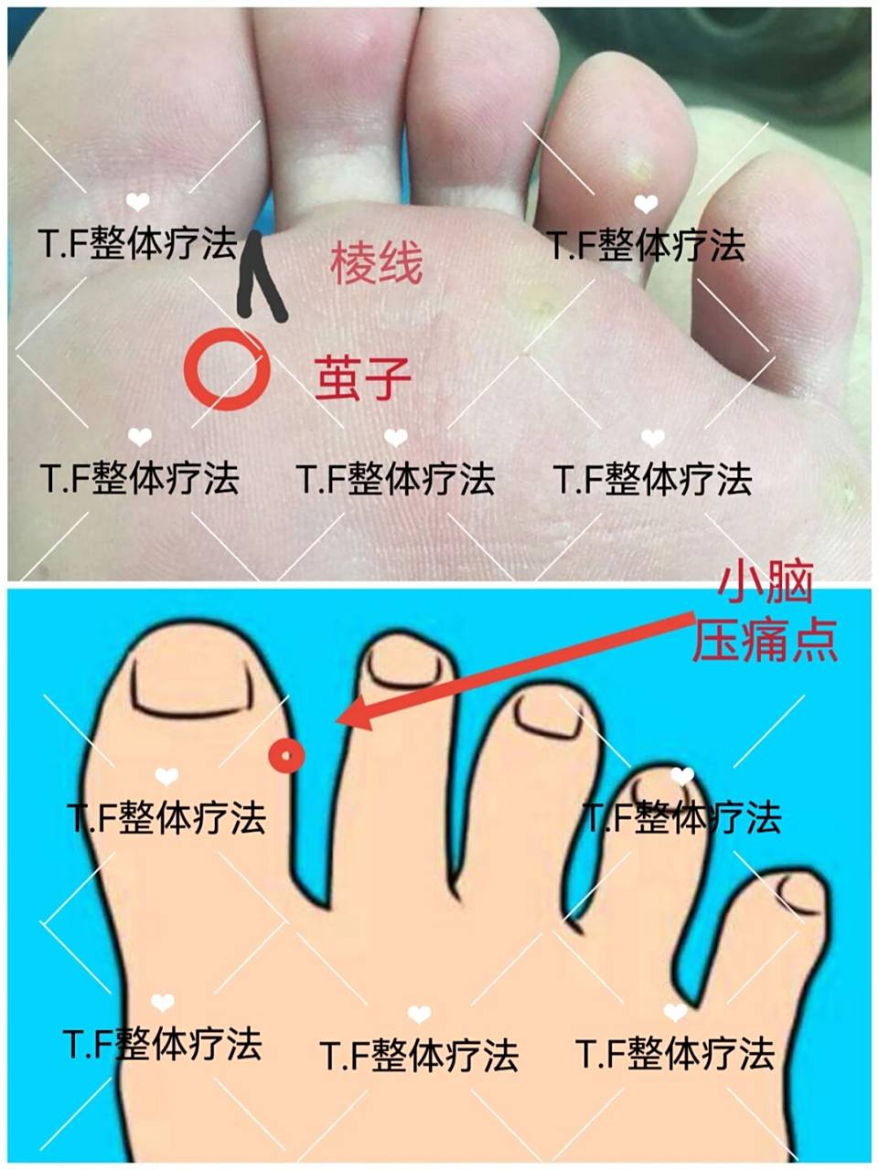 大脚趾与二脚趾之间下方,如果出现一条棱线 这个是痴呆线,严重的会