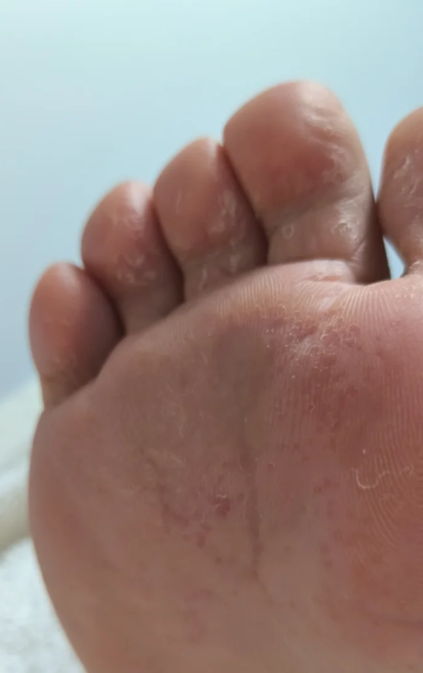 这种病是真菌感染引起的,容易在脚趾缝,脚底,脚跟和脚侧边出现,会传染