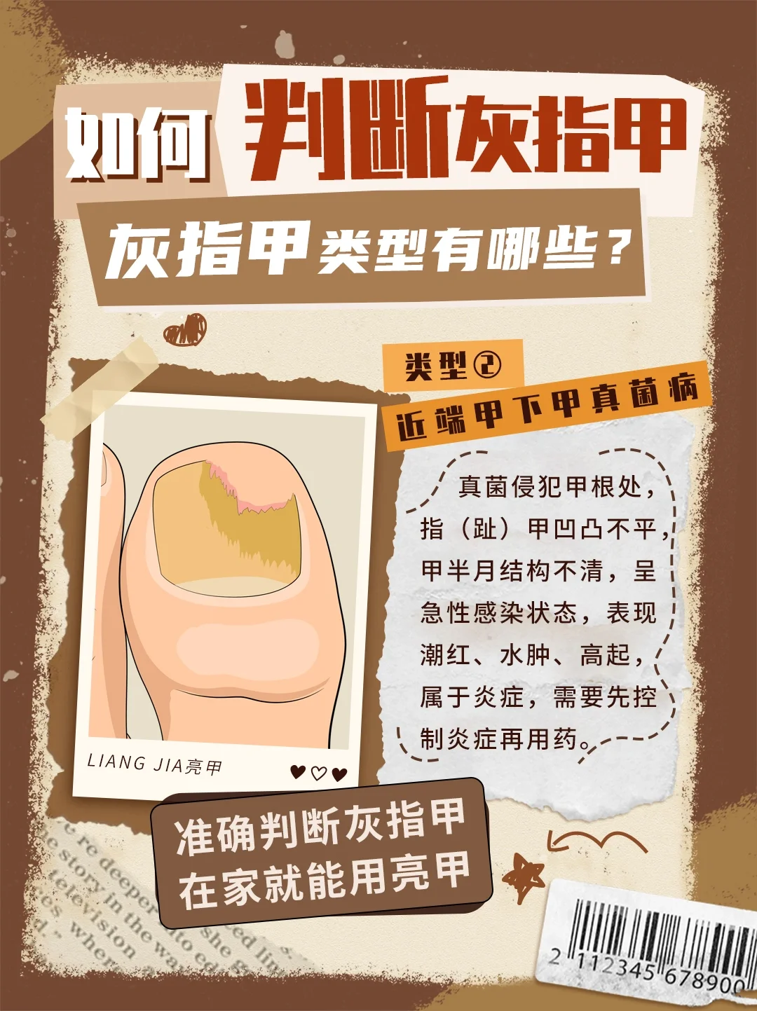 如何判断灰指甲? 灰指甲小课堂开始喽!今天就教你判断灰指甲类型!