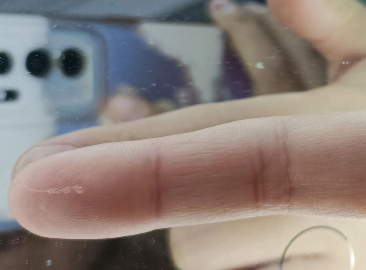 眼屎会拉丝…… 咋回事呢?