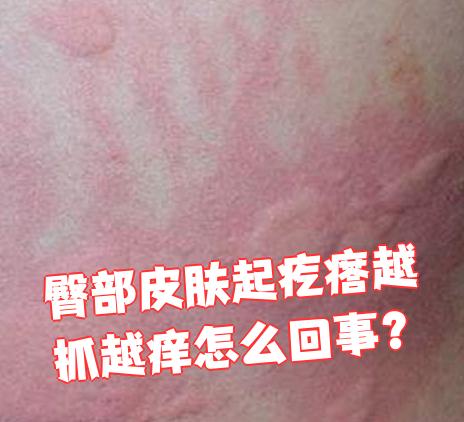 为什么身上起疙瘩还痒 为什么身上起疙瘩还痒