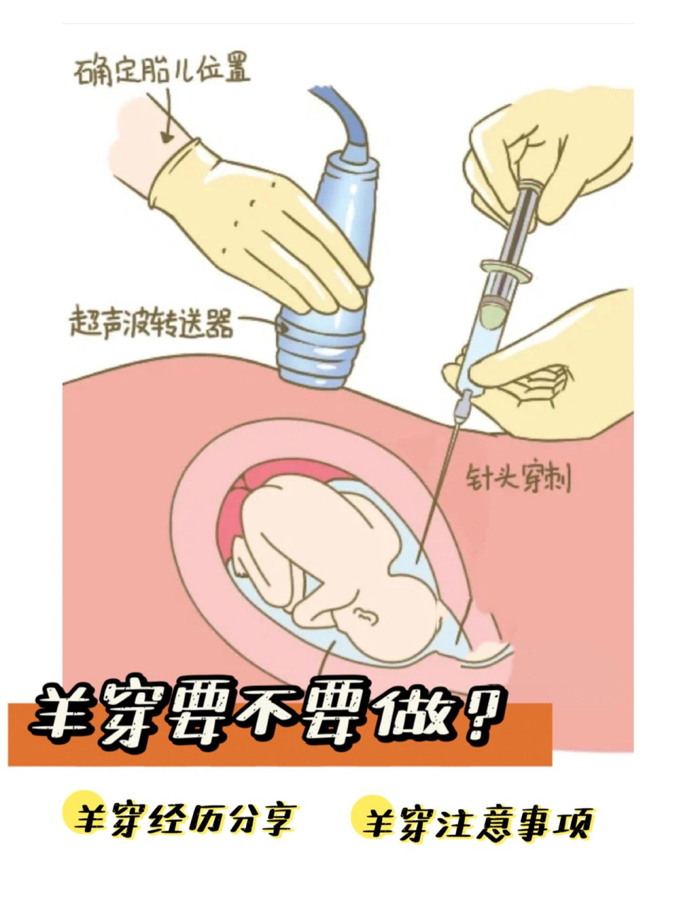 羊穿经历分享 羊水穿刺是一种侵入性检查,拿一根极细的针穿过肚皮和