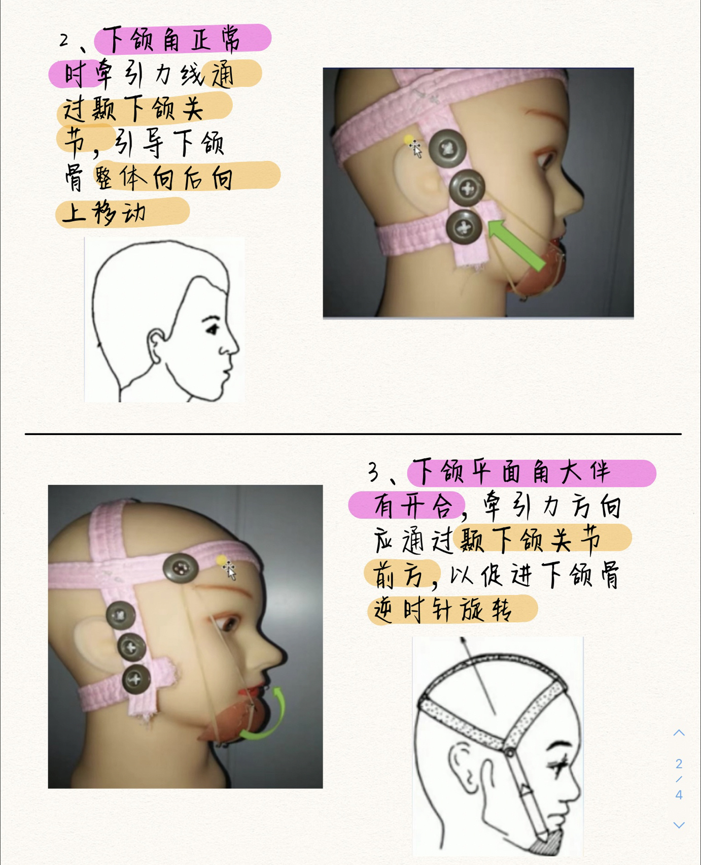92正畸21|下颌骨后方牵引|头帽颏兜