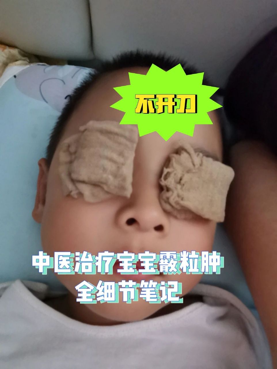 跟随祁宝玉大夫非手术中医治疗霰粒肿细节 没想到我第一篇小红书笔记