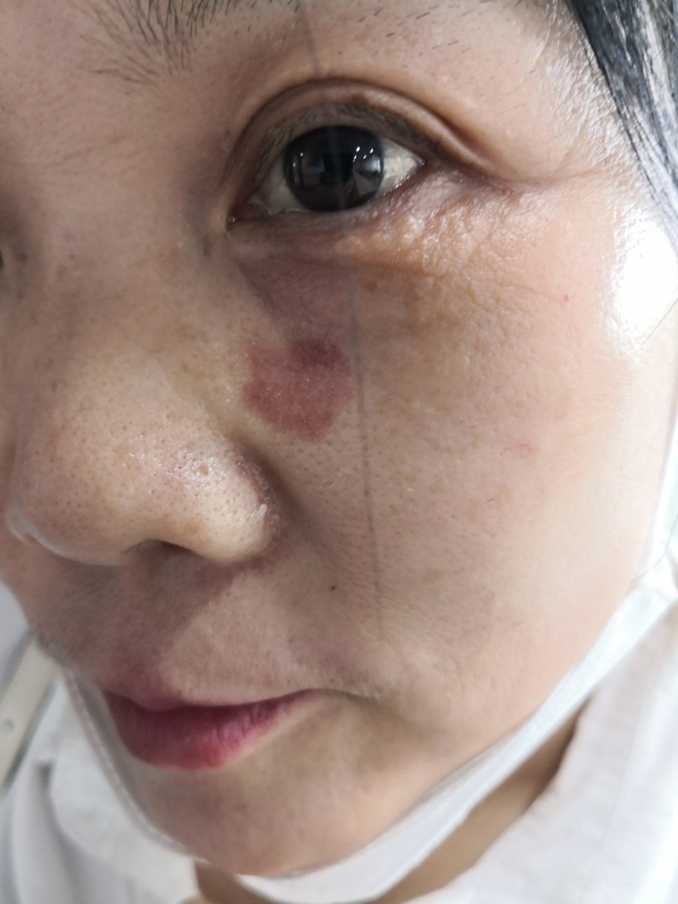 面部老年斑脂溢性角化激光治疗去除后恢复中#美容##解决皮肤问题专注