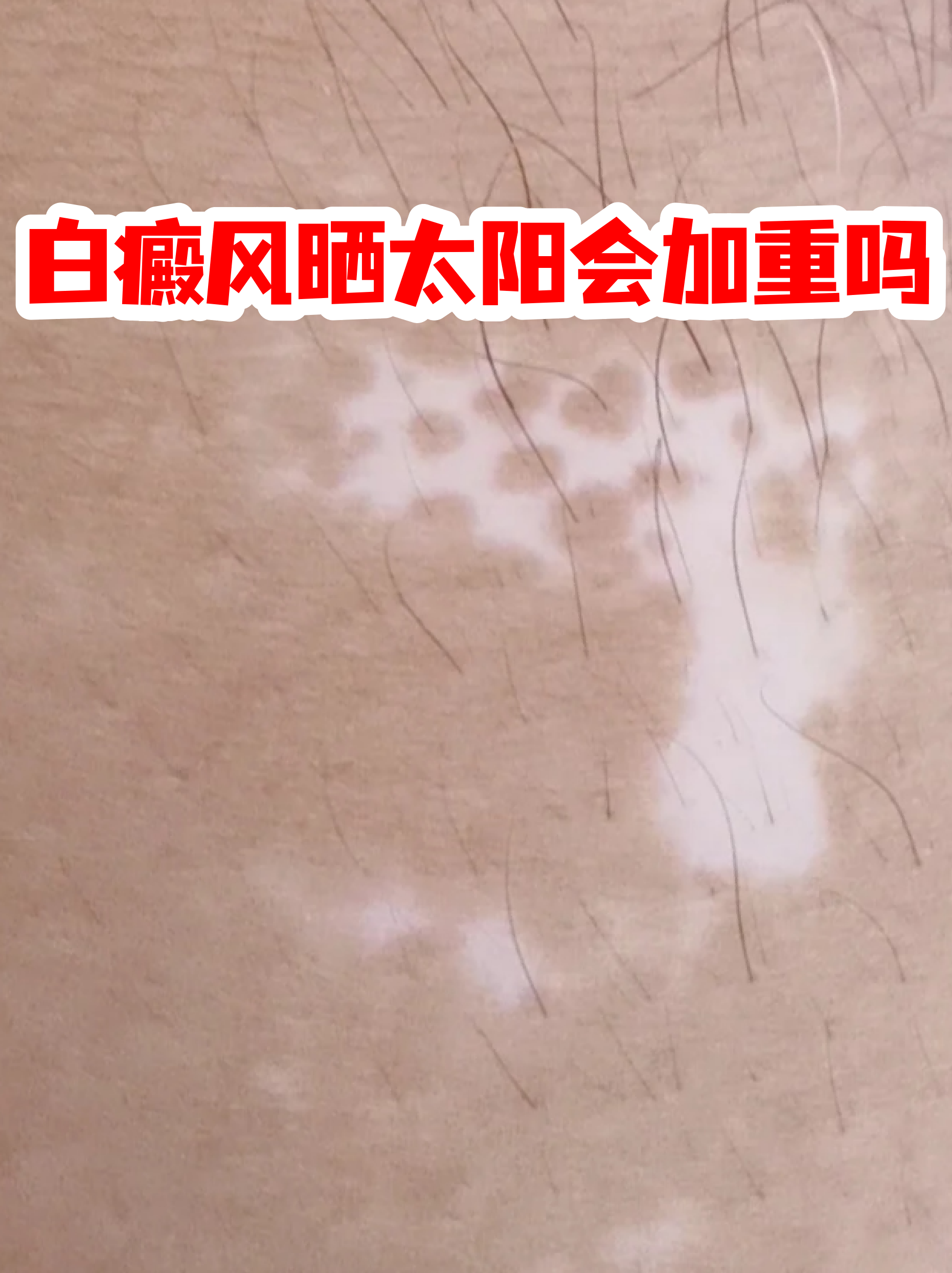 晒太阳的影响 可能加重病情:过量紫外线会刺激黑色素细胞,导致白斑