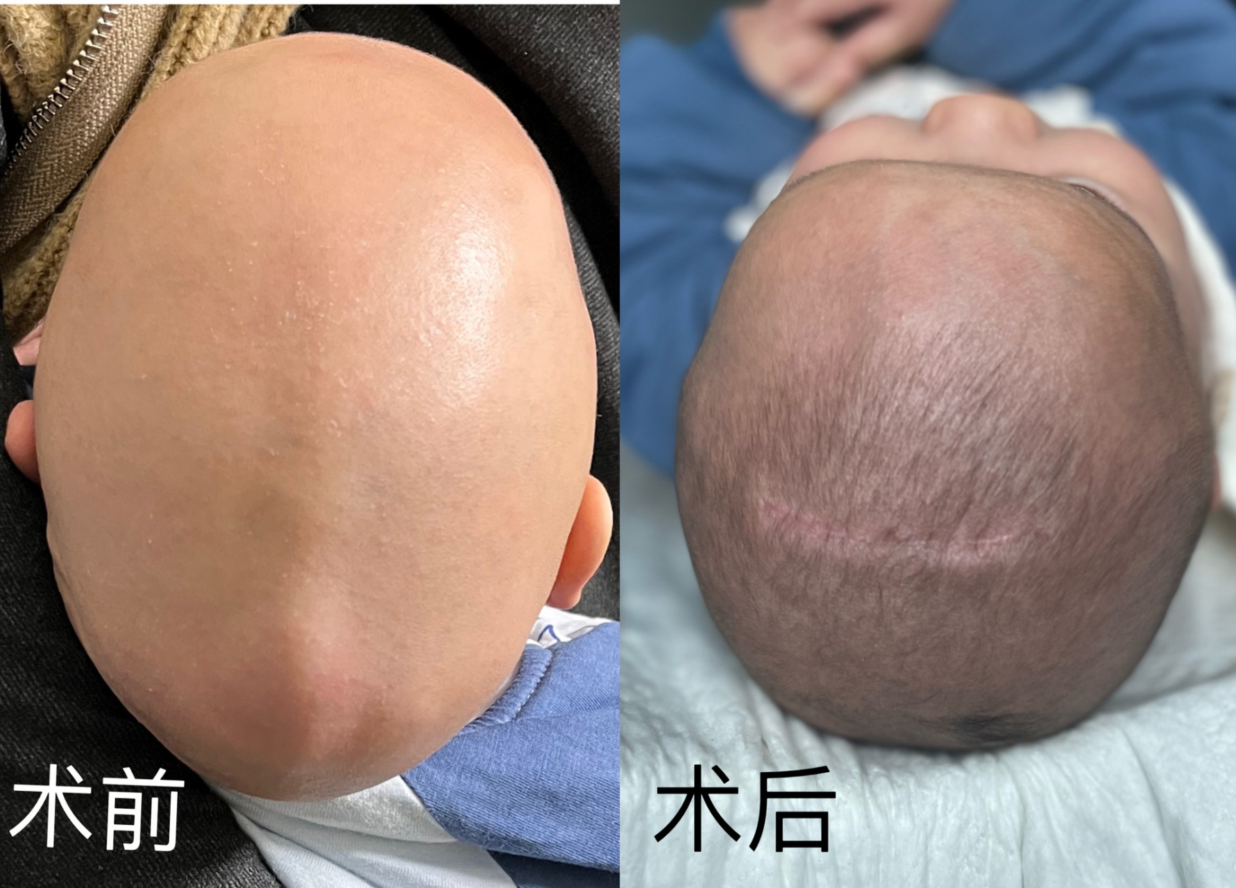矢状缝早闭术后一月 今天做了三月龄的儿保,还是满