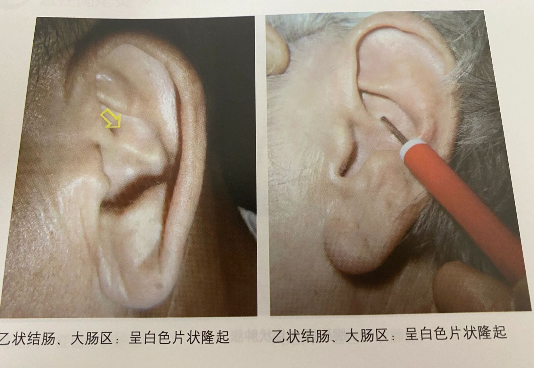 900169♀1501「神奇耳穴」观耳知便秘 临床中,我经常给病人