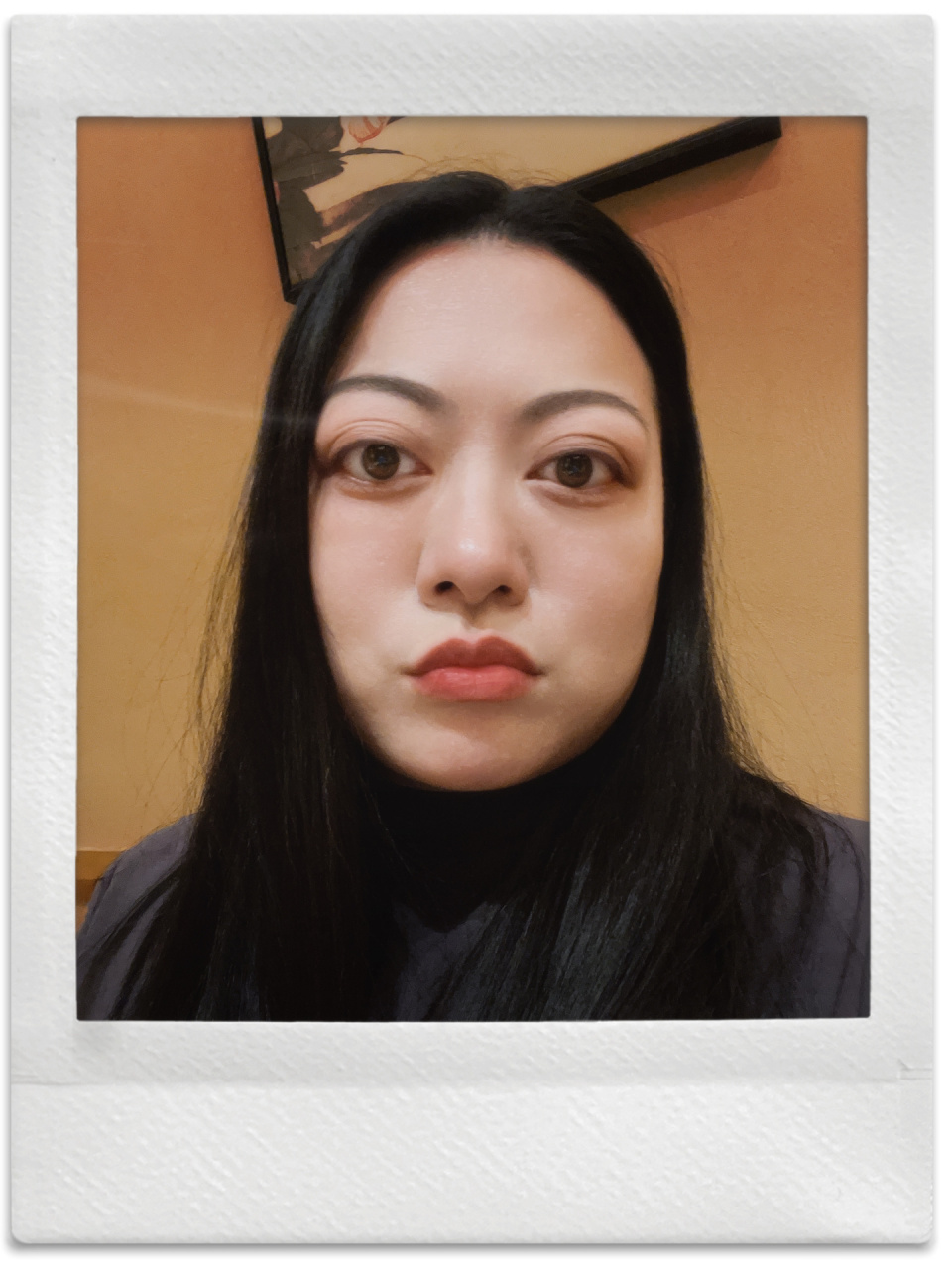 突眼的烦恼 甲亢前后对比图,从发现甲亢就是突眼,到现在依然突眼 不