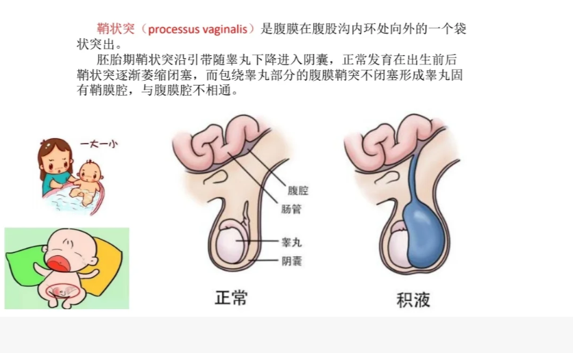 精索鞘膜积液主要有三个原因