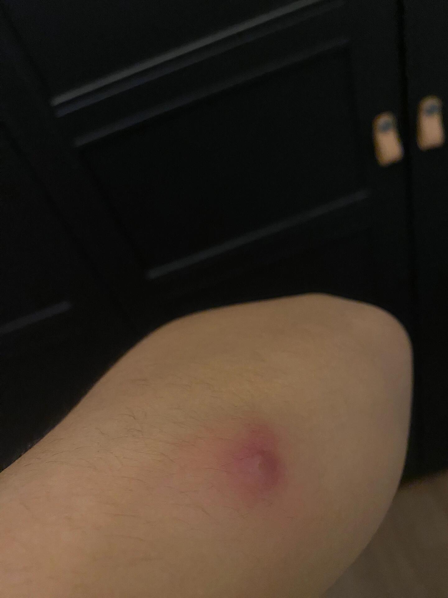 这是啥玩意儿啊 胳膊上莫名长了个疙瘩,刚开始像是