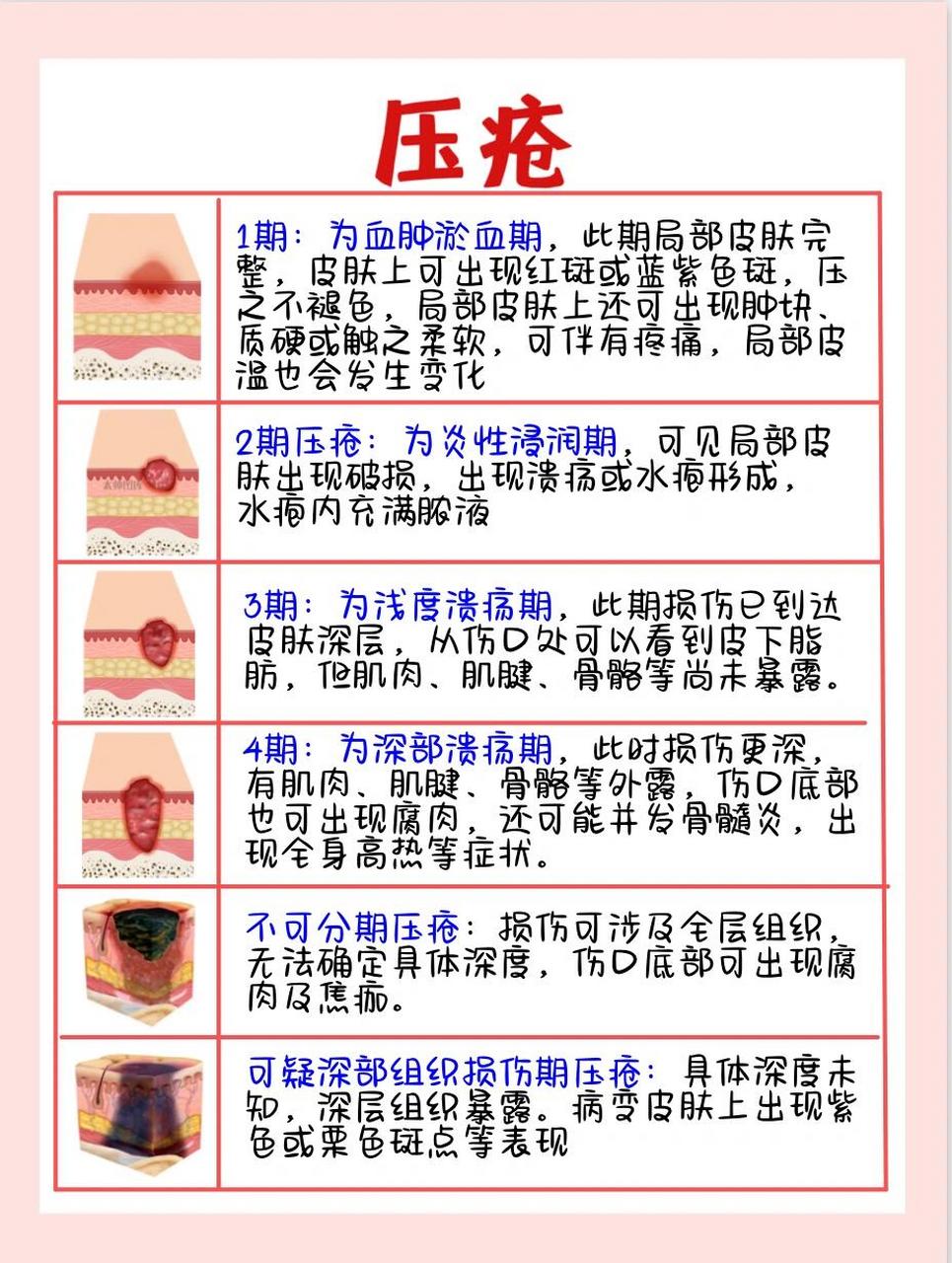 压疮分期图片