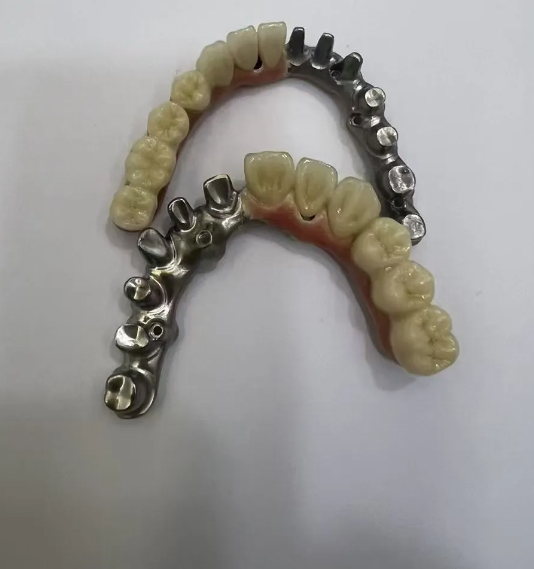 镶牙一颗大概多少钱?