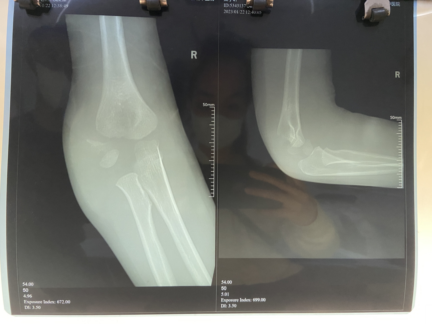 四岁的孩子,手肘撞骨折了,这种情况一定要做手术吗