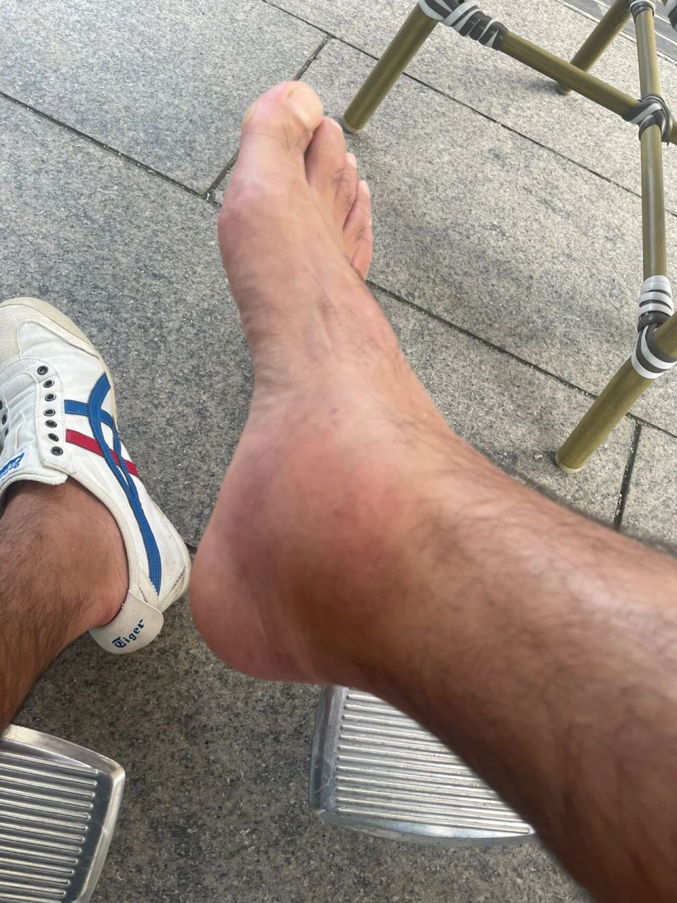 脚腕严重扭伤第三天,还肿的跟馒头一样 前天晚上踢球,右脚射门的一