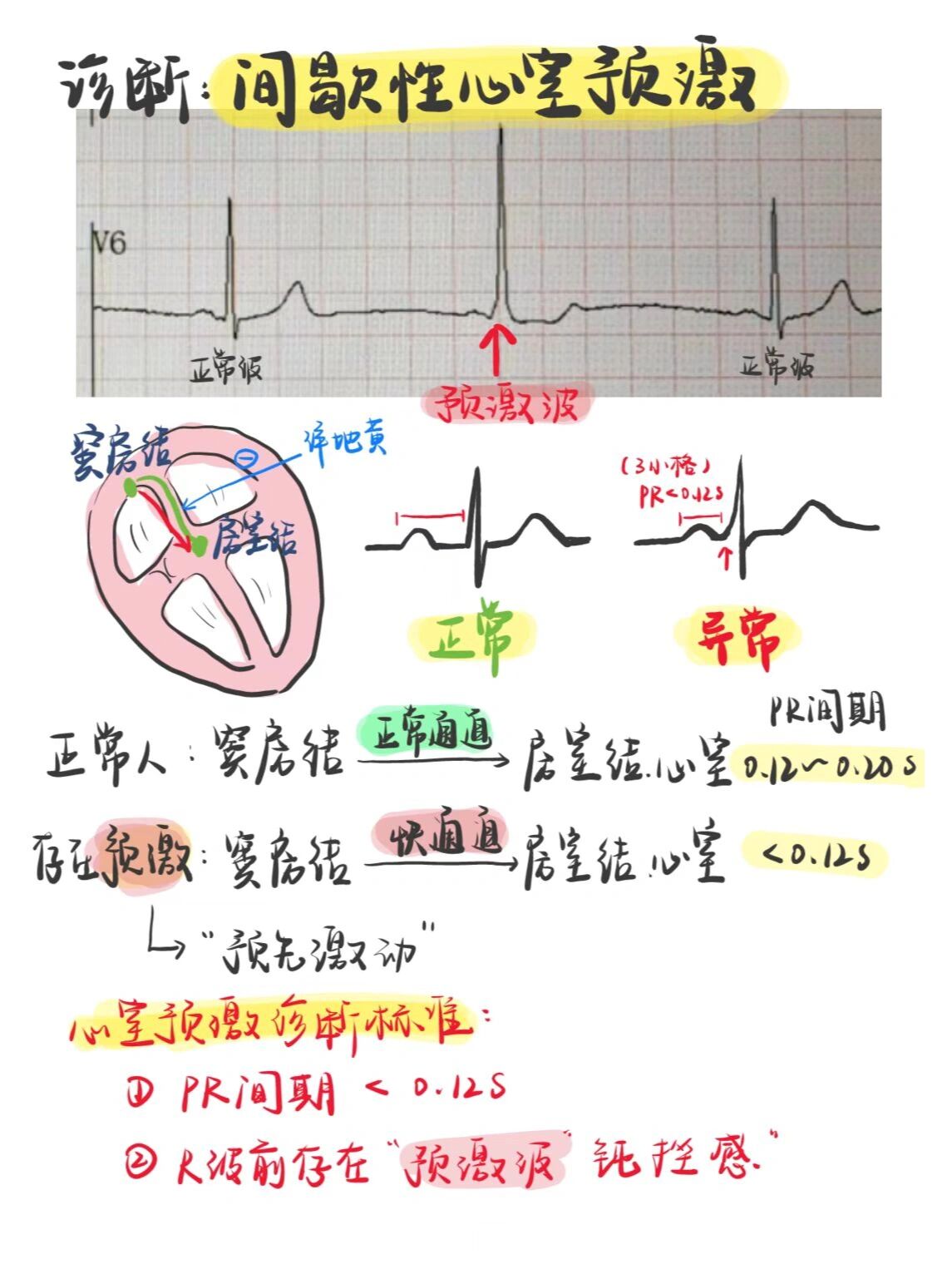 心室预激波心电图特点图片