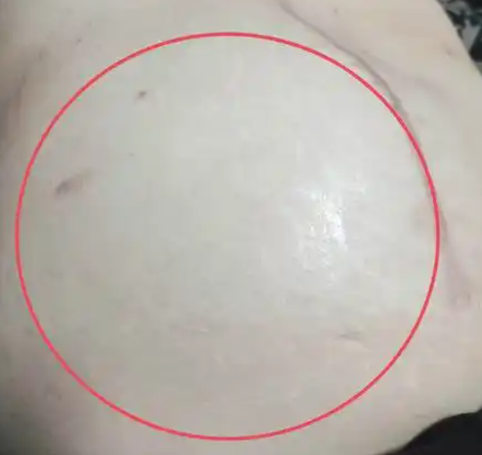 左腹部隐痛有硬块可能是便秘或肠道肿瘤引起的